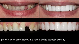 Prepless porcelain veneers with a "veneer" bridge - cosmetic dentistry.