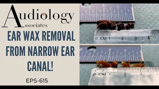 EAR WAX REMOVAL FROM A NARROW EAR CANAL - EP615