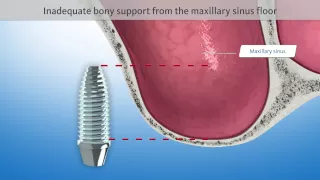 Sinus floor elevation (Dental Animation)