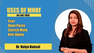 MNRF Laser for Acne Scars | Best treatment for Acne scar // Dr. Naiya Bansal