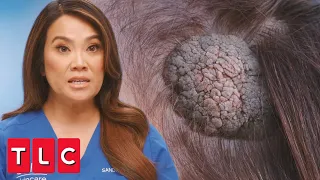 Patient Has a Spongy Bump on Her Head | Dr. Pimple Popper