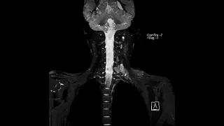 brachial plexus MR Imaging