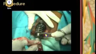 Master Class on Minimally Invasive Procedure for Prolapse and Hemorrhoid by Dr R K Mishra