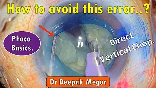 Phaco Basics. Direct Vertical Chop..How to avoid this error..? - Dr Deepak Megur