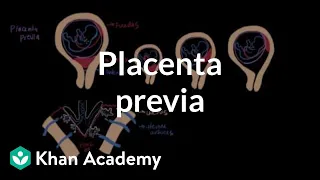 Placenta previa | Reproductive system physiology | NCLEX-RN | Khan Academy