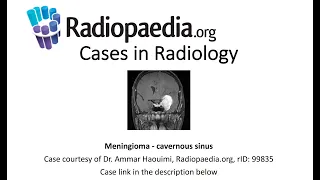 Meningioma - cavernous sinus (Radiopaedia.org) Cases in Radiology