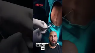 Colocación de catéter epidural