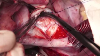 Surgery for Congenital Mitral Valve Disease (Type-IV) by Dr. V. Devagourou