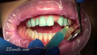 porcelain dental veneer bridge and veneers cosmetic dentistry before and after