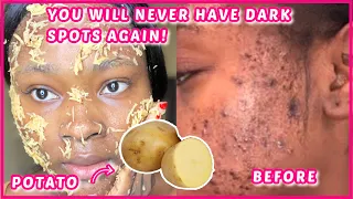 How to clear dark spot with potato in 7 days! | potato juice for dark spots | DIY potato face pack