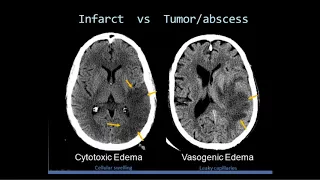 Intro to Head CT Part II: Evaluation of Ischemic Stroke