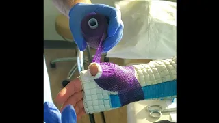 How to Make a Waterproof Thumb Spica Cast