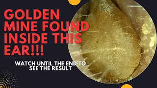 A GOLDEN Mine Found Inside This Ear!!! (Very Satisfying Earwax Removal Video)