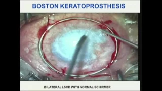 Surgical treatment of end stage ocular surface diseases: Tibial bone keratoprosthesis