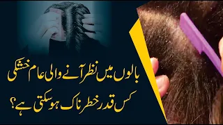 How Get Rid Of Dandruff | Causes Of Dandruff | Dandruff Urdu/ Hindi | By Dr. Amna Rasool