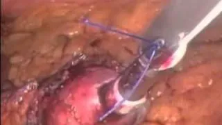 Laparoscopic Bilipancreatic Diversion With Duodenal Switch for Superobesity