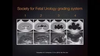 Grading Hydronephrosis on Bedside Ultrasound