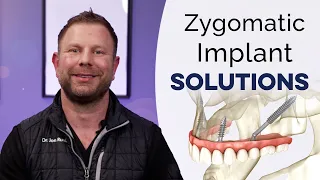 The Benefits of Zygomatic Dental Implants for Bone Loss Patients