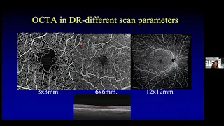 OCT-A Imaging to Identify Proliferative Diabetic Retinopathy