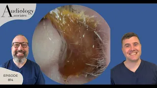 EAR WAX REMOVAL COMPILATION - EP814