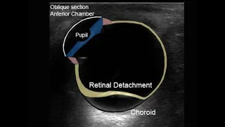 Ocular Ultrasound Lecture