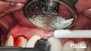 Functional crown lengthening around bleeding crown and veneer restorations