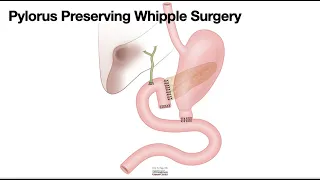 HCC 1475-10f-Surgical Anatomy-Pylorus Preserving Whipple