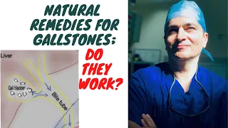 Gallbladder flush (home remedies) for gallbladder stones (gallstones); Do natural treatments work?