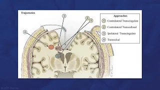 Contralateral Transfalcine-Transcingulate Resection of a Low-Grade Glioma