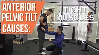 What causes Anterior Pelvic Tilt? Part 1: Tight Muscles in APT