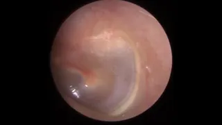 782 - Completely Blocked Ear Wax Removal & Dead Skin Extraction
