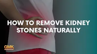 How to Remove Kidney Stones Naturally (Part 1) | Usapang Pangkalusugan