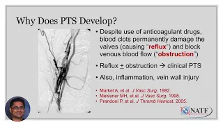 Understanding Post-thrombotic Syndrome