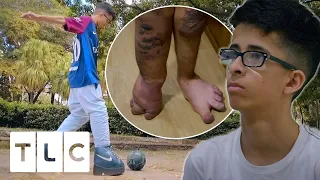 Brazilian Teen’s Mobility Is Threatened By Proteus Syndrome | Body Bizarre