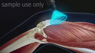 Shockwave Therapy 3d medical animation sample use only