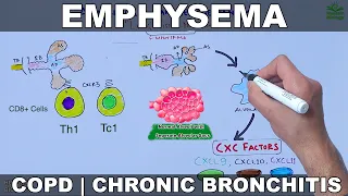 Emphysema | COPD