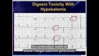 Mattu EKG Vakası: Wellens ve Ters Wellens ayrımı - 13 Mayıs 13 Türkçe Altyazılı - Acilci.Net