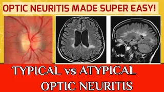 OPTIC NEURITIS || Typical optic neuritis and atypical optic neuritis