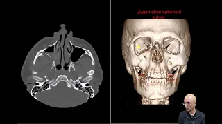 ZMC fracture