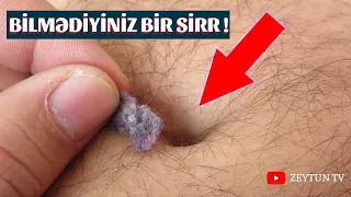 Göbək Dəliyində Pambığın Yaranmasının ŞOK SƏBƏBİ! İnanmayacaqsınız!