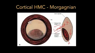 Lens - Part 2: Cataract - Pathophysiology & Types