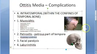 ENT Complications of Otitis Media Acute Chronic AtticoAntral CSOM middle ear infection result