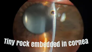 Cornea foreign body: tiny hard rock embedded in eye