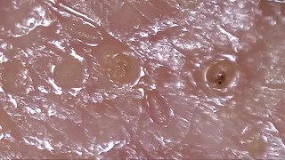 My Face Skin Demodex video