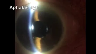 Aphakic eye