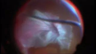 A vitrectomy for endophthalmitis with terrible outcome