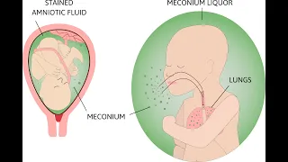 Meconium Aspiration Syndrome and HIE