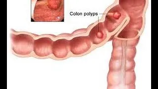 What is a Colon Polyp? | Los Angeles Colonoscopy