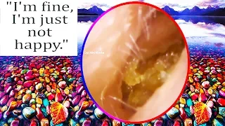 Most Satisfying Ear Wax Removal With Sleeping Musice & Quotes Related The Live