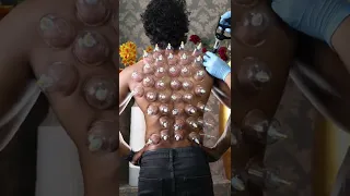 அருவியாய் கொட்டும் குடுவை சிகிச்சை அருணின் முதுகில் இருந்து #cupping #cuppingtherapy #chennai #face